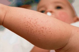 Dermatitis Atópica