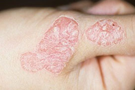 Psoriasis